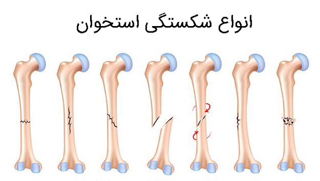 انواع شکستگی بازو
