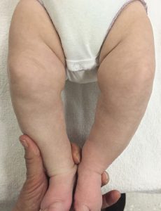 پای پرانتزی در نوزاد